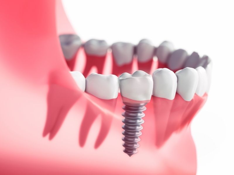 her-hastaya-implant-uygulanabilir-mi