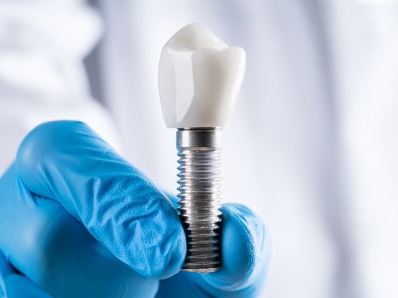 implantlarin-uzerine-protez-nasil-yerlestirilir